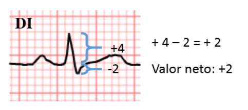 Amplitud neta del complejo QRS en DI