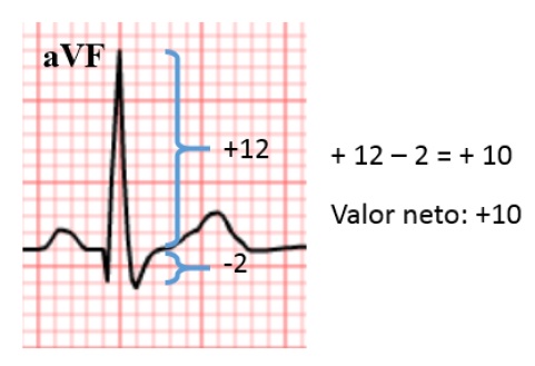 Amplitud neta del complejo QRS en aVF