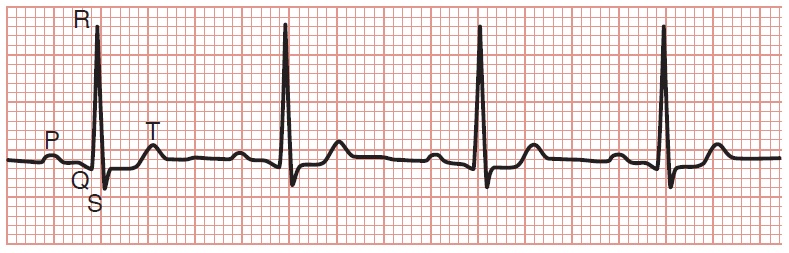 Electrocardiograma normal